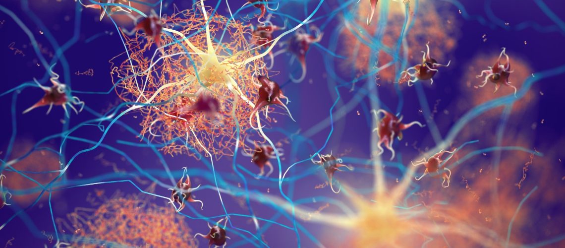 Amyloid plaques forming between neurons 3d ilustration.