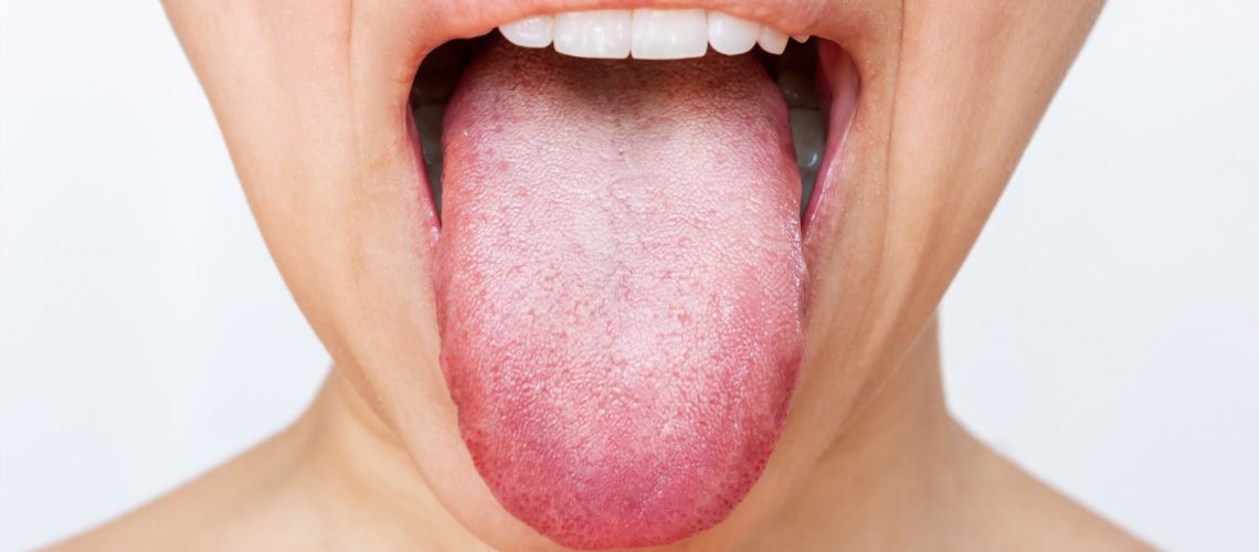 Female tongue with a white plaque