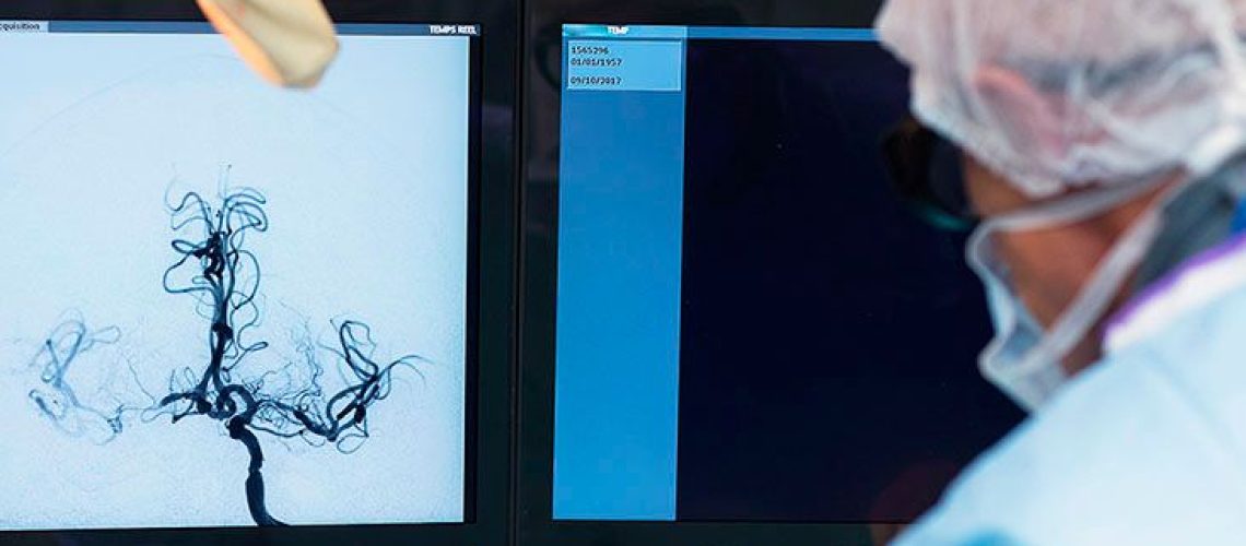 כריתת טרומבקטומיה 'יעיל מאוד' טיפול ארוך טווח לאחר שבץ, אומר המחקר