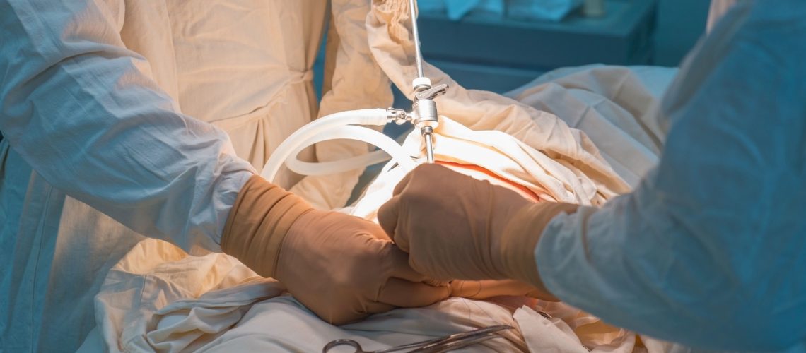 Study: Comparison of Sleeve Gastrectomy vs Roux-en-Y Gastric Bypass: A Randomized Clinical Trial. Image Credit: Donenko Oleksii / Shutterstock.com