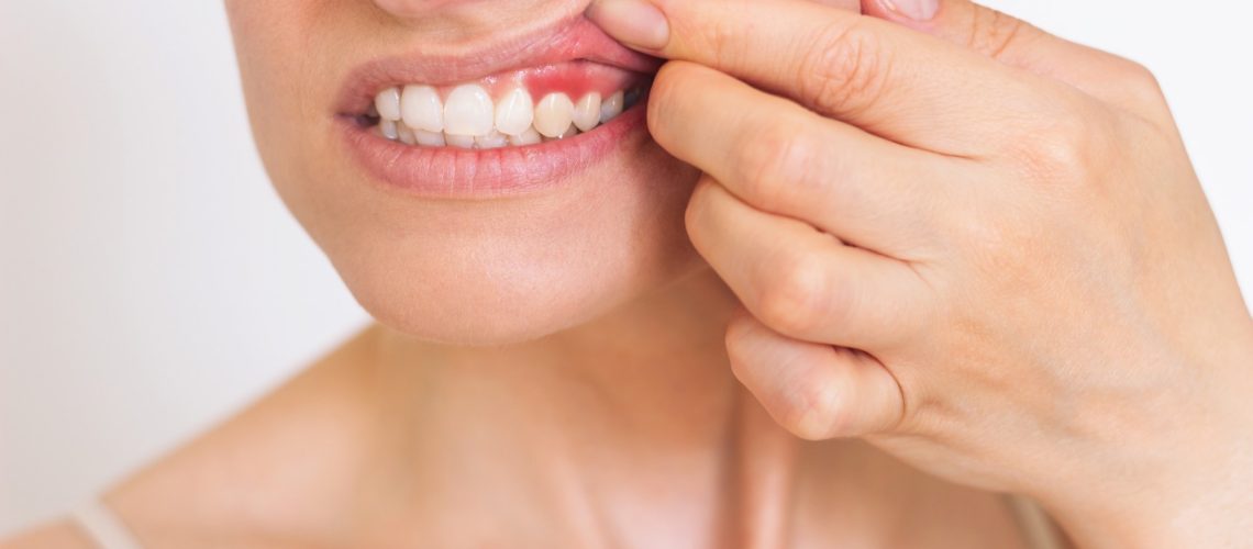 ​​​​​​​Study: Periodontitis, Dental Procedures, and Young-Onset Cryptogenic Stroke. Image Credit: Olga by Shefer/Shutterstock.com