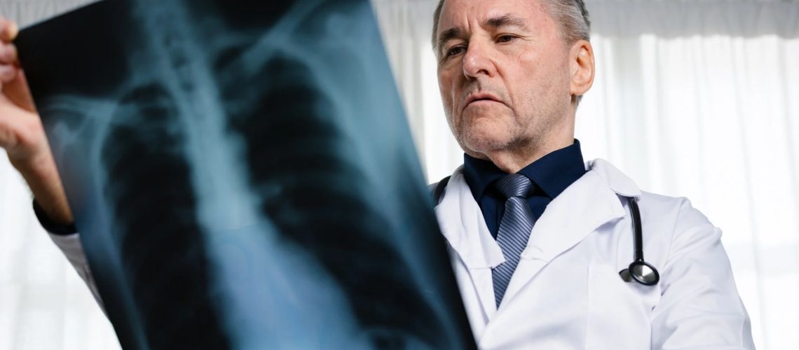 Opinion: Lung cancer in never smokers: from early detection to prevention. Image Credit: Thx4Stock team / Shutterstock