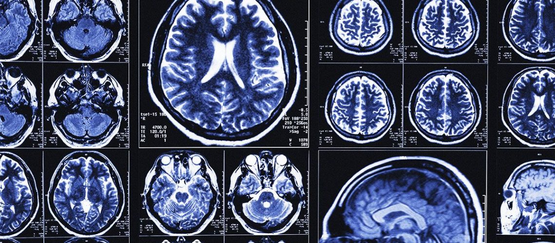 מדענים יוצרים כלי בינה מלאכותית שעוזר לחזות אלצהיימר עם דיוק של עד 82%.