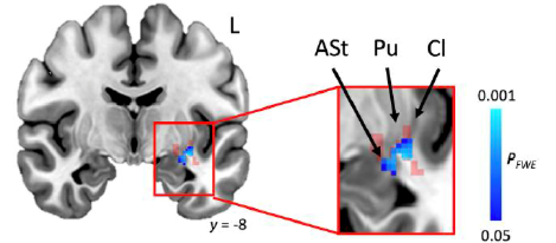 Scientists locate the source of stuttering in the brain