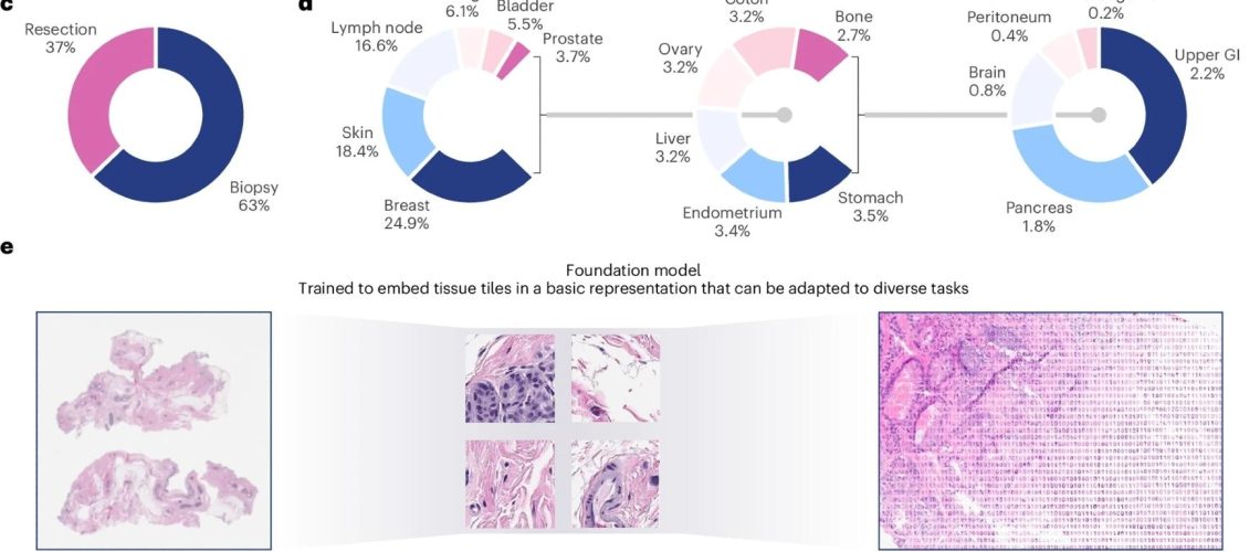 The training dataset, training algorithm and application of Virchow, a foundation model for computational pathology. a, The training data can be described in terms of patients, cases, specimens, blocks or slides, as shown. b–d, The slide distribution as a function of cancer status (b), surgery (c) and tissue type (d). e, The dataflow during training requires processing the slide into tiles, which are then cropped into global and local views. f, Schematic of applications of the foundation model using an aggregator model to predict attributes at the slide level. GI, gastrointestinal. Study: A foundation model for clinical-grade computational pathology and rare cancers detection