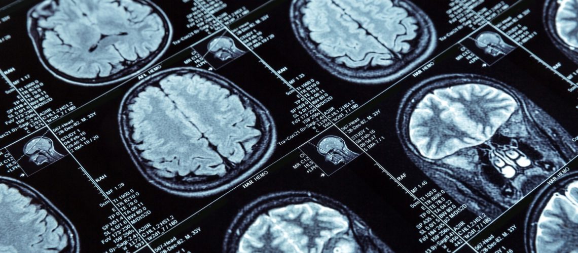 Study: Using brain structural neuroimaging measures to predict psychosis onset for individuals at clinical high-risk. Image Credit: Nomad_Soul/Shutterstock.com