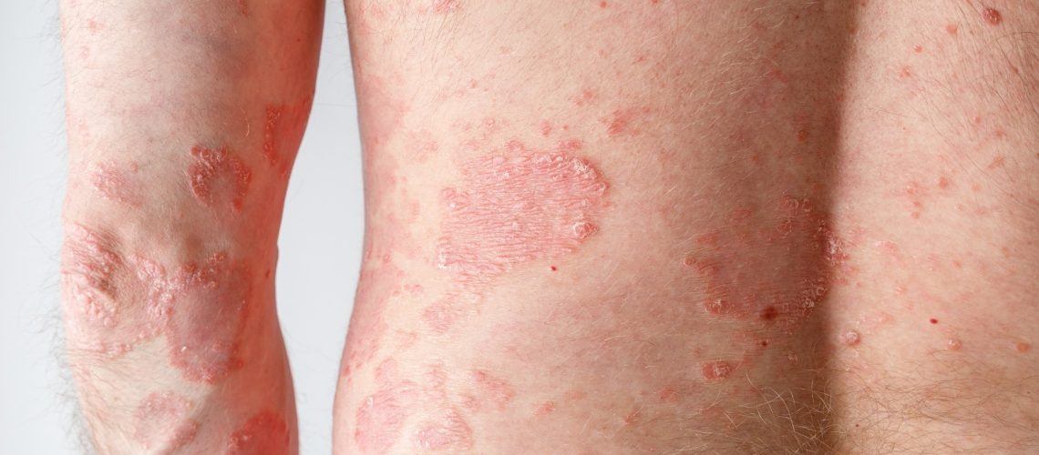 מזונות מעובדים במיוחד מגבירים את הסיכון לפסוריאזיס פעילה, כך עולה ממחקר