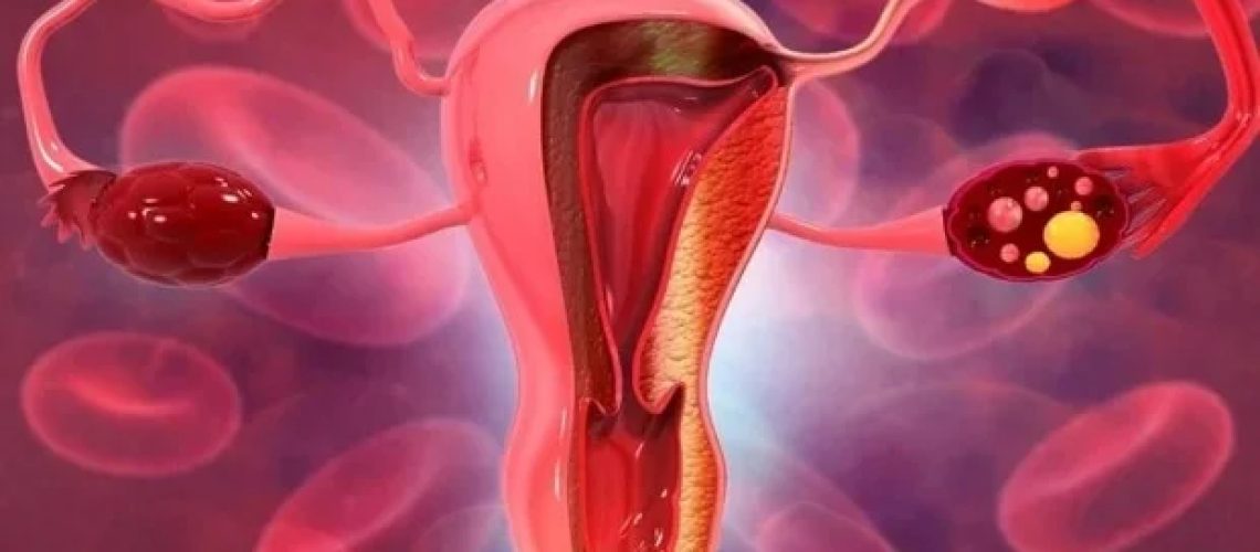 מחסומים קליניים מונעים גישה לטיפול הורמונלי לאחר טיפול בסרטן צוואר הרחם