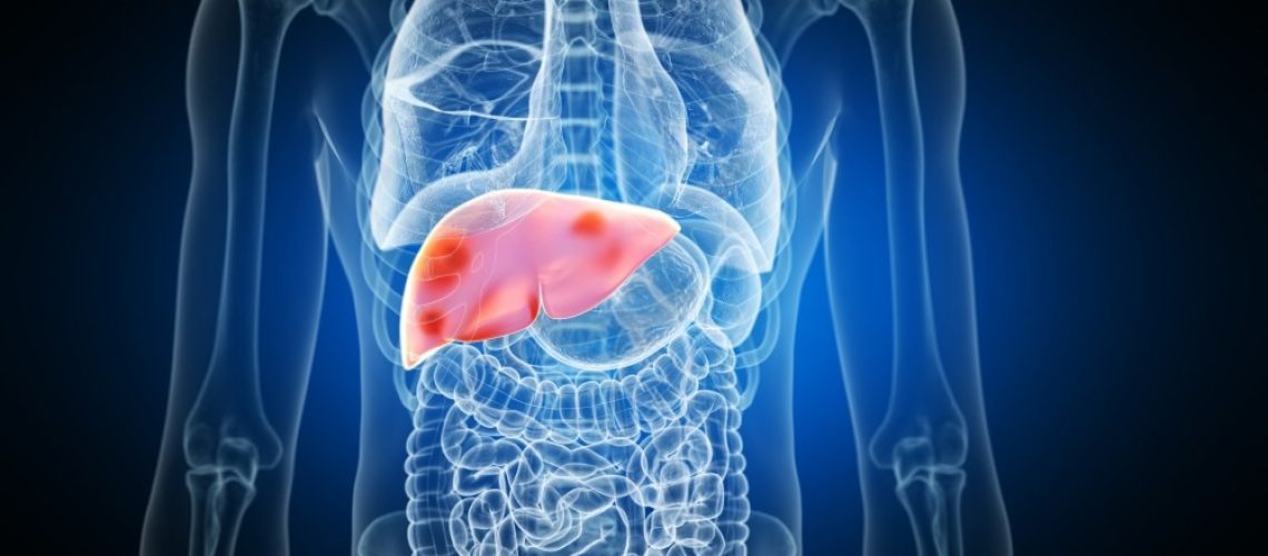 3d rendered medically accurate illustration of liver tumors