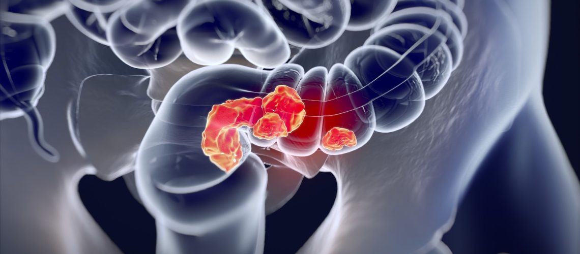 Study: Genome-wide interaction study of dietary intake of fibre, fruits, and vegetables with risk of colorectal cancer. Image Credit: Anatomy Image / Shutterstock