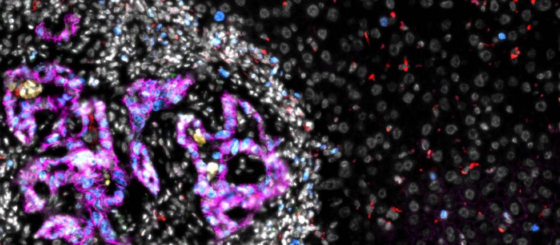 New study reveals how colorectal cancer cells establish liver metastases