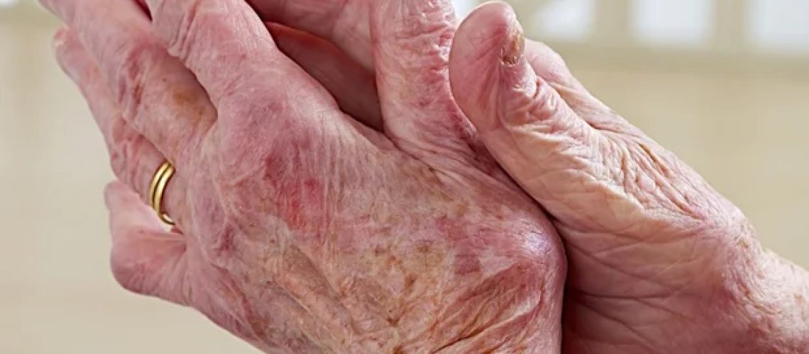 מחקר חדש ממפה שינויים מולקולריים מוקדמים באוסטיאוארתריטיס במפרק הלסת