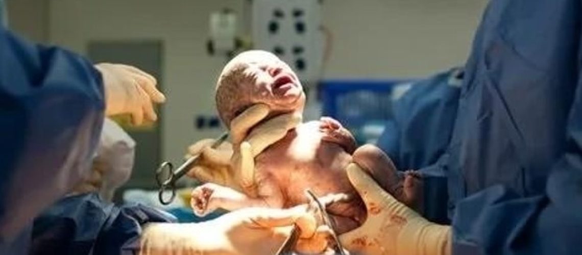 מחקר חדש תומך בהרדמה כללית כאופציה ללידות קיסריות