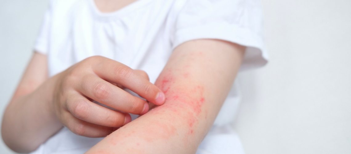 Study: Neonatal Vitamin D and Associations with Longitudinal Changes of Eczema up to 25 Years of Age. Image Credit: marishkaSm / Shutterstock