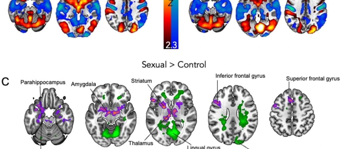 Women with HSDD have greater limbic activation to sexual videos than men. (A) The female and (B) male HSDD group average results showing the brains activation (red/yellow) and deactivation (blue green) to sexual compared to control (exercise) videos. (C) Brain regions more activated in women (relative to men) to sexual compared to control videos are shown in purple. Brain regions more activated in men (relative to women) to sexual compared to control videos are shown in green. Results are cluster corrected and thresholded to Z = 2.3, P < 0.05, N = 64 (32 women, 32 men). Study: Women with HSDD have greater limbic activation to sexual videos than men. (A) The female and (B) male HSDD group average results showing the brains activation (red/yellow) and deactivation (blue green) to sexual compared to control (exercise) videos. (C) Brain regions more activated in women (relative to men) to sexual compared to control videos are shown in purple. Brain regions more activated in men (relative to women) to sexual compared to control videos are shown in green. Results are cluster corrected and thresholded to Z = 2.3, P < 0.05, N = 64 (32 women, 32 men). Study: Women and men with distressing low sexual desire exhibit sexually dimorphic brain processing