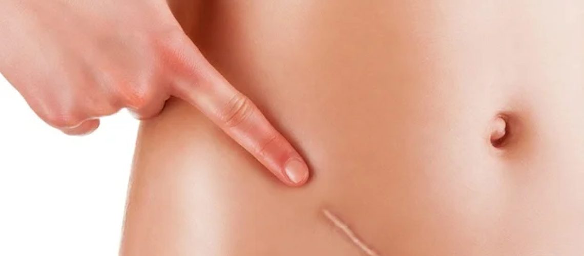 מחקר מאמת את OVCAR3 כמודל לסרטן שחלות בדרגה גבוהה