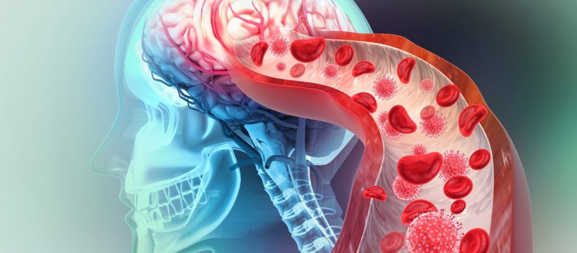 מחקר מגלה גורמים גנטיים המפתחים סיכונים קרדיווסקולריים לאחר שבץ