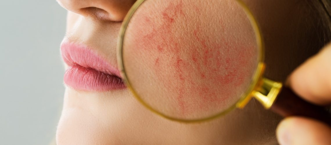 Study: Rosacea is strongly associated with melanoma in Caucasians. Image Credit: Andrey_Popov/Shutterstock.com