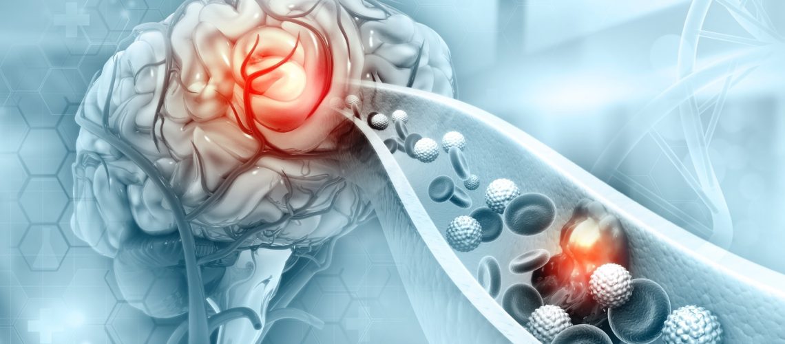Study: Overweight in adolescence and young adulthood in association with adult cerebrovascular disease: the NFBC1966 study. Image Credit: crystal light / Shutterstock.com