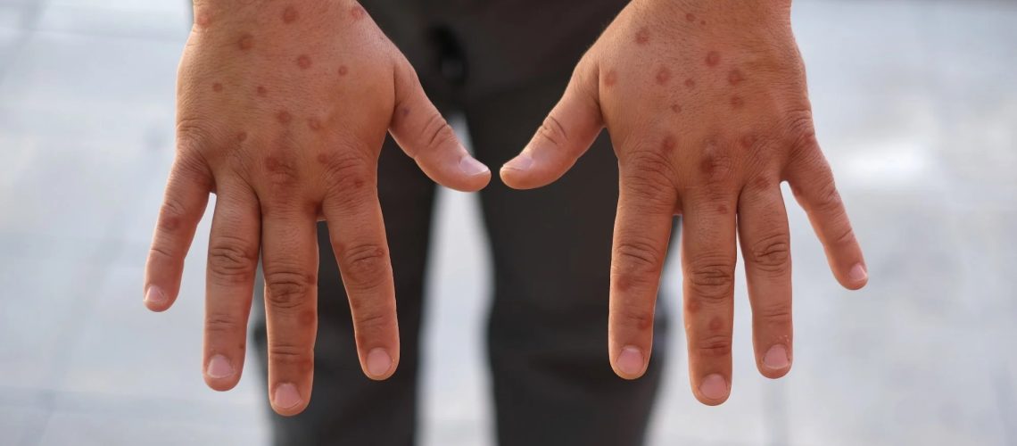 Study: The Incubation Periods of Mpox Virus Clade Ib. Image Credit: Selman GEDIK /  Shutterstock