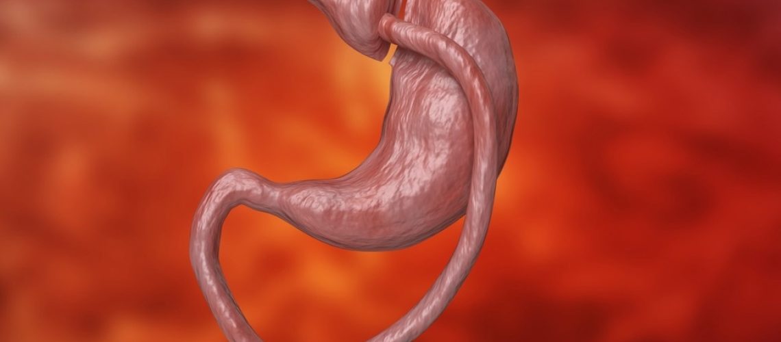Study: Gastric Bypass vs Diet and Cardiovascular Risk Factors A Nonrandomized Controlled Trial. Image Credit: Adao/Shutterstock.com
