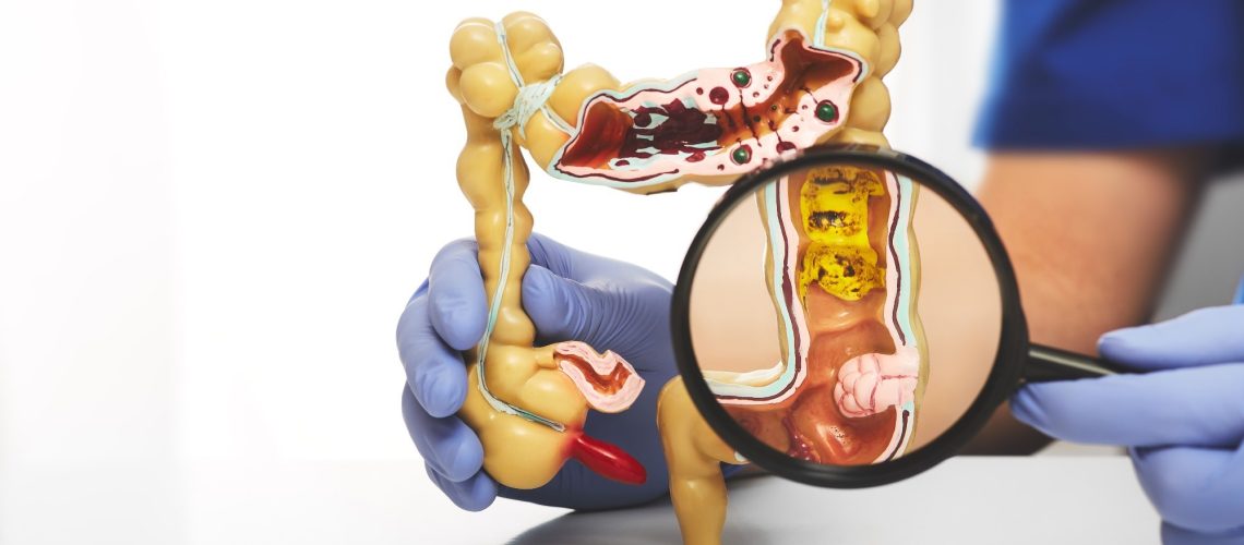 מחקר קושר בין זיהום אוויר לסיכון מוגבר לסרטן המעי הגס באמצעות שינויים ב-DNA