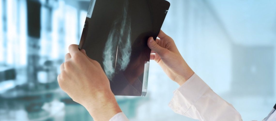 Study: Association of travel time, patient characteristics, and hospital quality with patient mobility for breast cancer surgery: A national population-based study. Image Credit: Guschenkova/Shutterstock.com