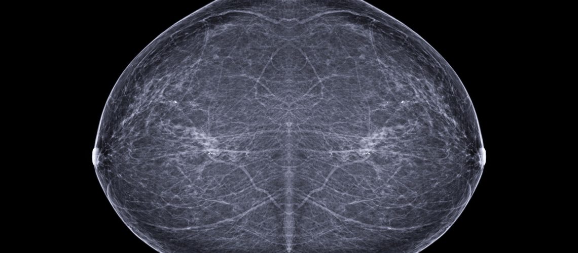 Early Indicators of the Impact of Using AI in Mammography Screening for Breast Cancer