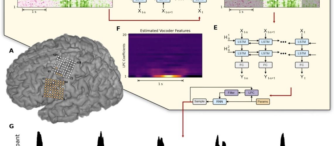 Overview of the closed-loop speech synthesizer. (A) Neural activity is acquired from a subset of 64 electrodes (highlighted in orange) from two 8 × 8 ECoG electrode arrays covering sensorimotor areas for face and tongue, and for upper limb regions. (B) The closed-loop speech synthesizer extracts high-gamma features to reveal speech-related neural correlates of attempted speech production and propagates each frame to a neural voice activity detection (nVAD) model (C) that identifies and extracts speech segments (D). When the participant finishes speaking a word, the nVAD model forwards the high-gamma activity of the whole extracted sequence to a bidirectional decoding model (E) which estimates acoustic features (F) that can be transformed into an acoustic speech signal. (G) The synthesized speech is played back as acoustic feedback.