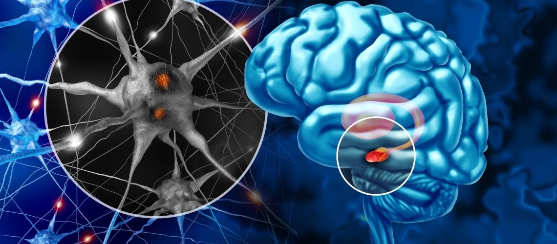 Study: Sleep and Parkinson’s disease: a population-based study from the CHARLS cohort.
