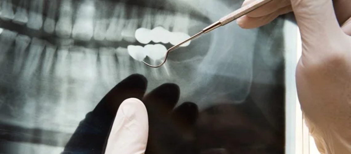 מערכת אוטומטית משפרת את דיוק הלמידה העמוק בניתוח רדיוגרפיה של החזה