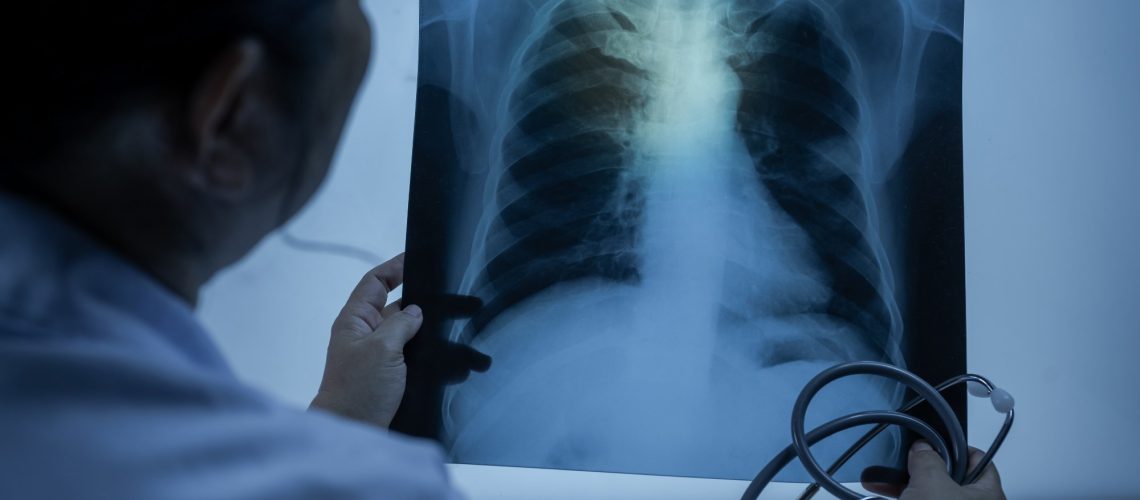 משולבת Quabodepistat מראה הבטחה לטיפול בטוח יותר, מהיר יותר בשחפת