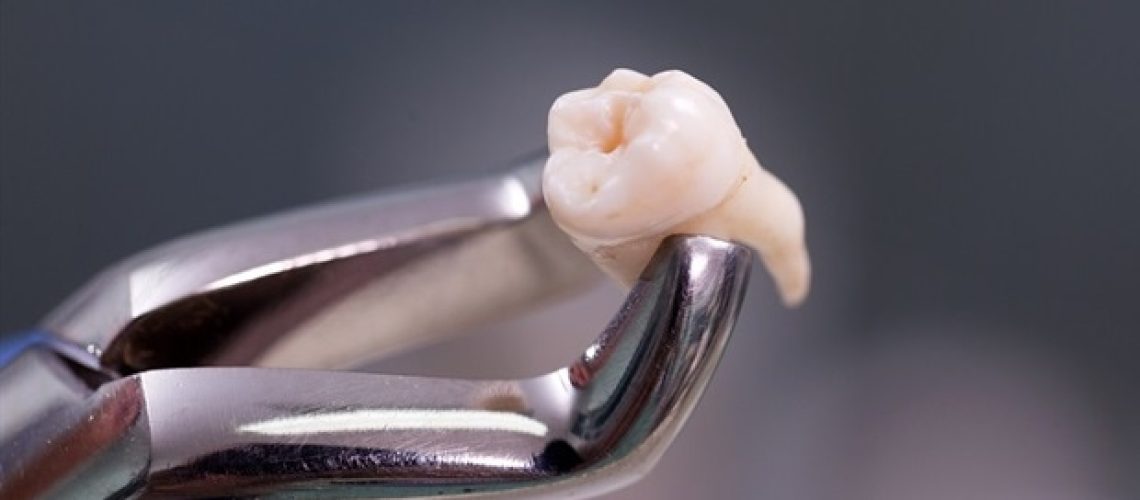 משככי כאבים ללא מרשם עולים על אופיואידים לאחר עקירת שן בינה