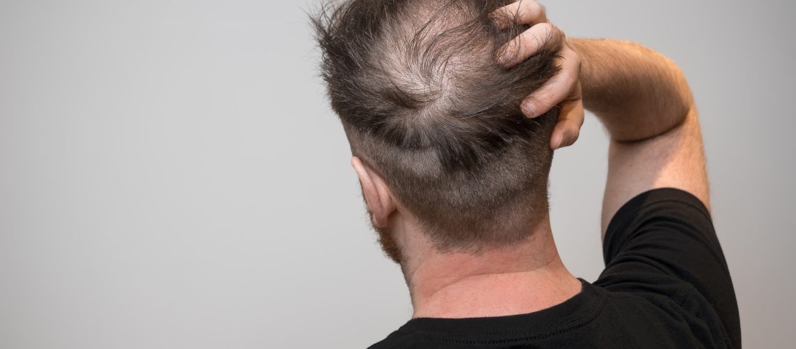 Assessing the relationship between dietary factors and hair health: A systematic review. Image Credit: Chris Curry / Shutterstock