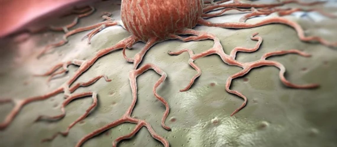 נויטרופילים מזדקנים מקדמים את הישרדות הגידול בין סוגי הסרטן