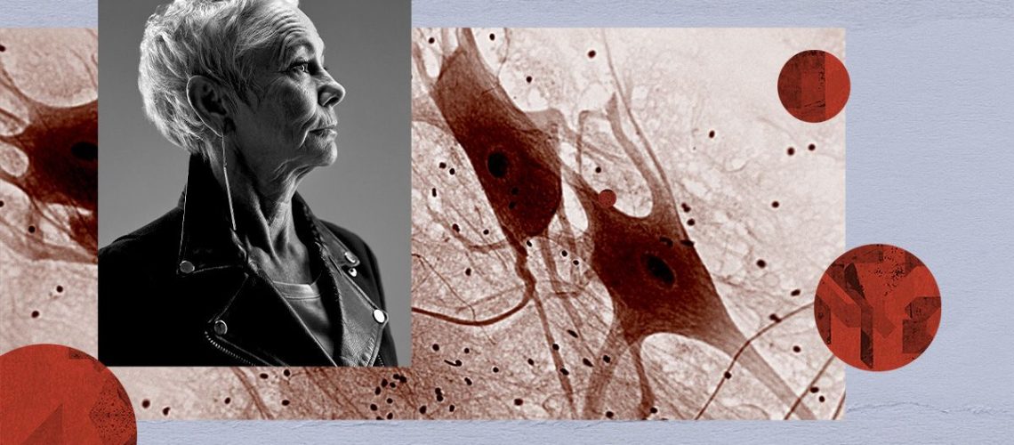 ניהול כולסטרול עשוי לסייע בהורדת הסיכון לאלצהיימר, מחלת פרקינסון