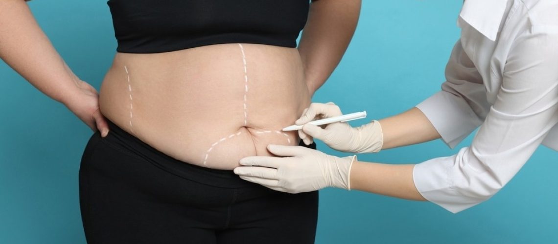 Study: Breast Cancer Risk After Bariatric Surgery and Influence of Insulin Levels A Nonrandomized Controlled Trial. Image Credit: New Africa/Shutterstock.com