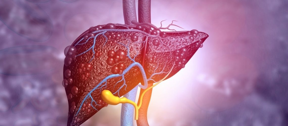 Study: Association of non-alcoholic fatty liver disease with cardiovascular disease and all cause death in patients with type 2 diabetes mellitus: nationwide population based study. Image Credit: Explode/Shutterstock.com
