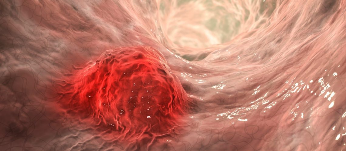 3D illustration showing malignant tumor in intestine