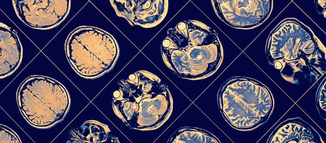 New landscape of the diagnosis of Alzheimer