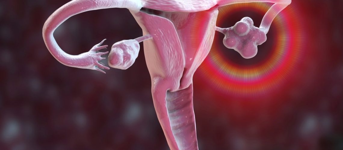 Study: Diagnosis and management of polycystic ovarian syndrome. Image Credit: Kateryna Kon/Shutterstock.com