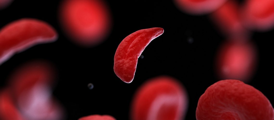 Study: Sickle Cell Disease Update: New Treatments and Challenging Nutritional Interventions. Image Credit: SciePro/Shutterstock.com