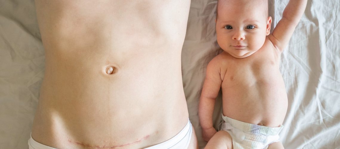 Closeup of woman belly with a scar from a cesarean section and her baby