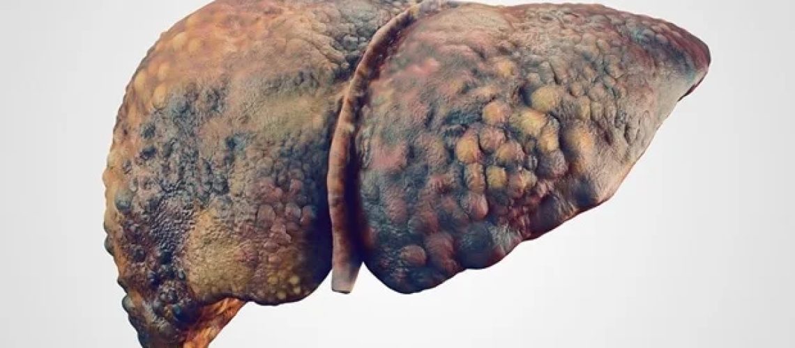 עדכון AGA קורא למעקב טוב יותר אחר קרצינומה הפטוצלולרית