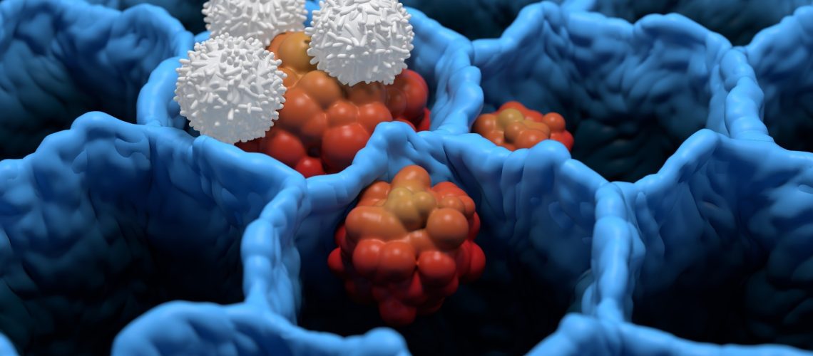 עירוי בודד של תאי T מהונדסים משיג הפוגה מתמשכת של אסתמה בעכברים