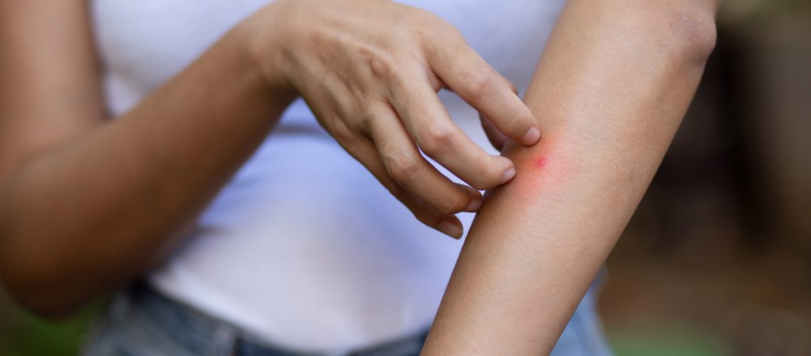 Woman scratching mosquito bite