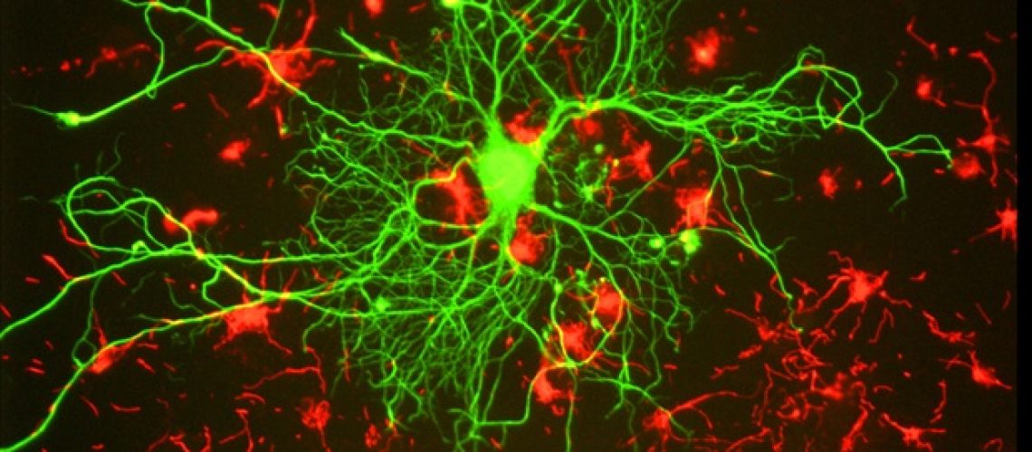 פיזיקת הפולימרים מציעה נקודות מבט חדשות על מחלות ניווניות