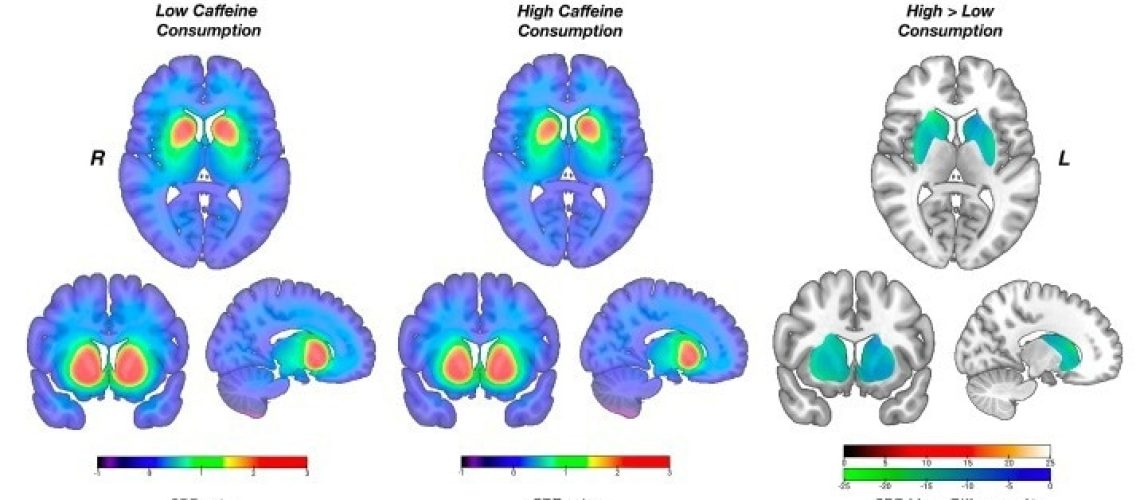 Chronic caffeine intake may impact brain chemistry in Parkinson