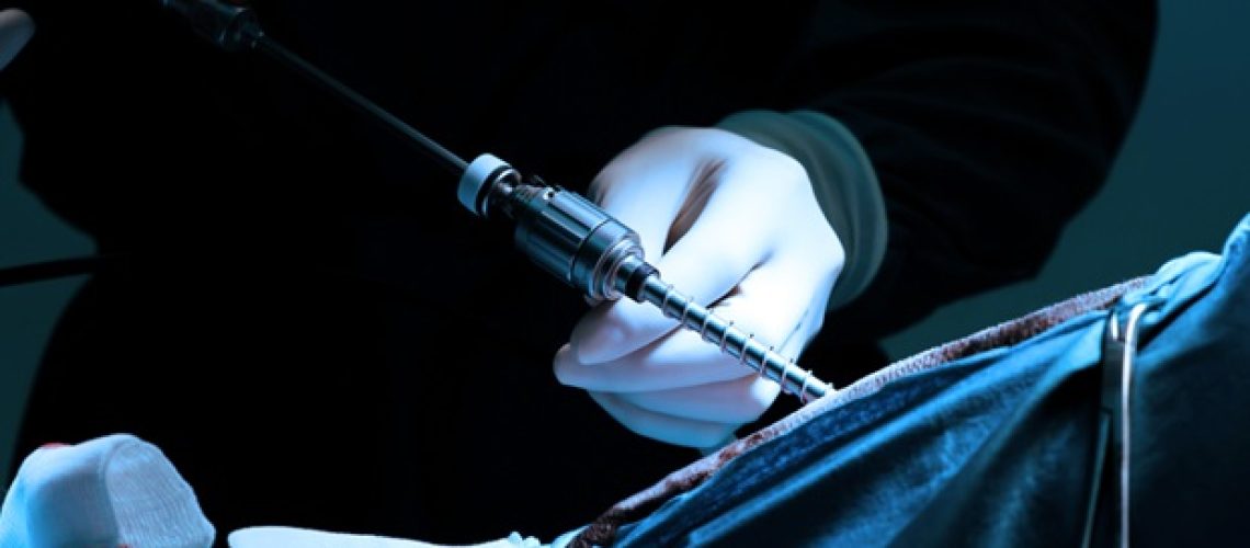 שיטה כירורגית חדשה יכולה להפוך אלטרנטיבה לטיפול בקע המפשעה אצל נשים