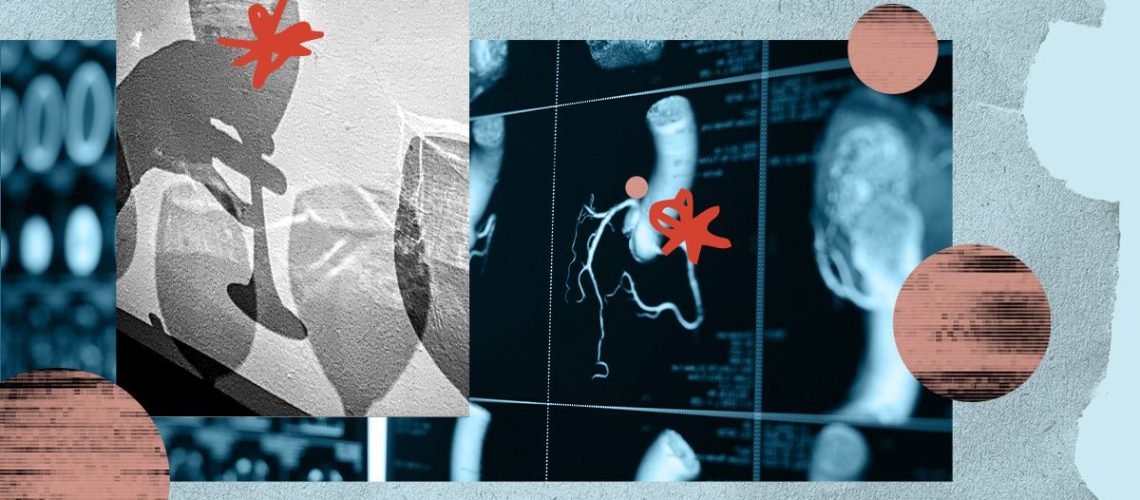 שימוש באלכוהול עלול לגרום לפרפור פרוזדורים, לבעיות לב אחרות